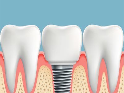 dental-implant-illustration